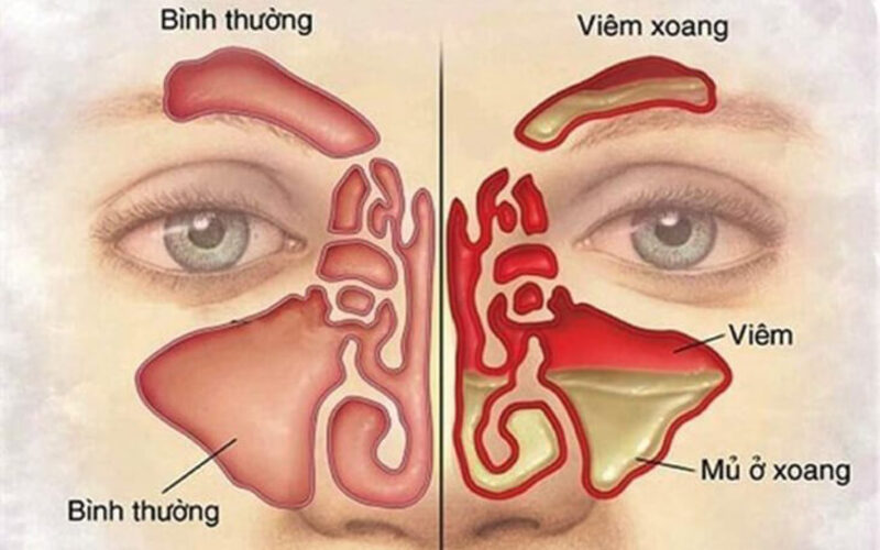 Nâng mũi đau đầu có thể là do bệnh lý viêm xoang gây nên 