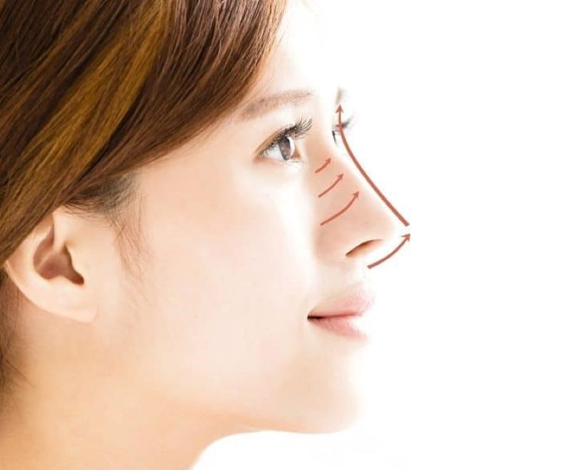 Nâng mũi bằng chỉ collagen Hàn Quốc lành tính và an toàn với cơ thể