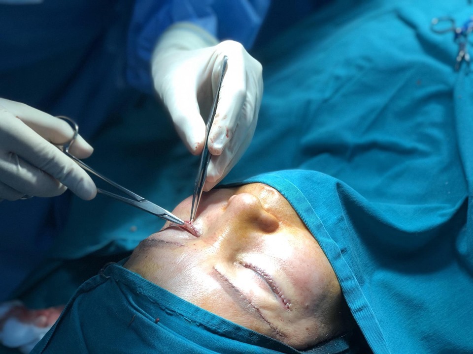 Bác sĩ có tay nghề kém có thể làm tăng nguy cơ mí mắt bị cắt quá dài