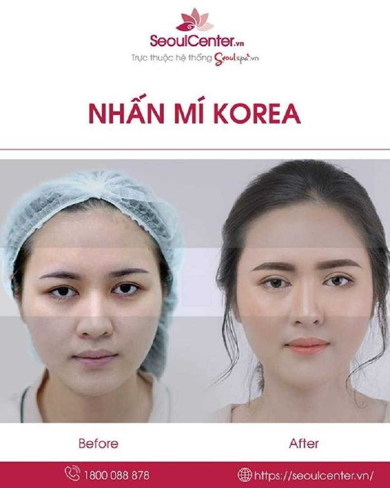 Kỹ thuật nhấn mí Hàn Quốc giúp mí mắt tự nhiên, hài hoà với gương mặt