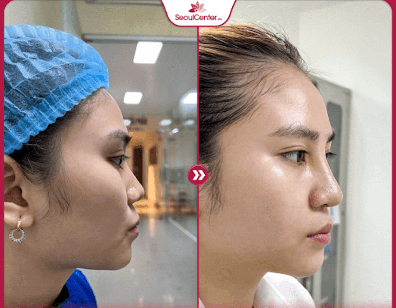 Kết quả dáng mũi Sline bọc sụn 2 lớp của chị khách sau khi nâng mũi