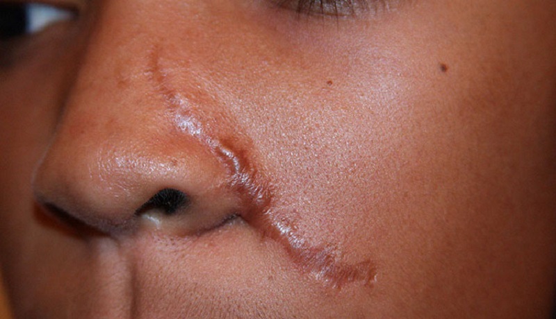 Sẹo kém thẩm mỹ xuất hiện trên mũi nếu tiến hành phẫu thuật tại địa chỉ hoạt động chui