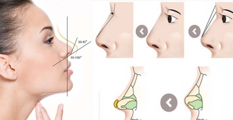 Phẫu thuật nâng mũi bằng sụn mang lại hiệu quả trên 10 năm