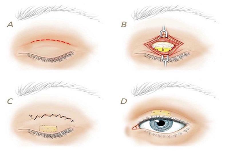 Kỹ thuật cắt mí mini open giúp bạn có được đôi mắt đẹp, to tròn