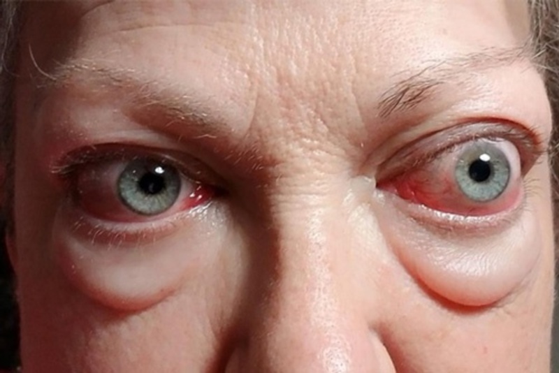 Mắt lồi do ảnh hưởng của các bệnh lý nền