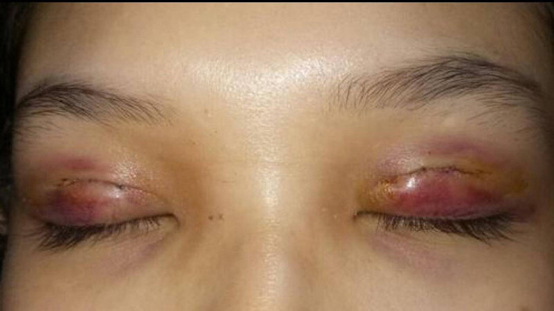 Mắt lồi sẹo và viêm đỏ do cắt mí mắt bị hỏng
