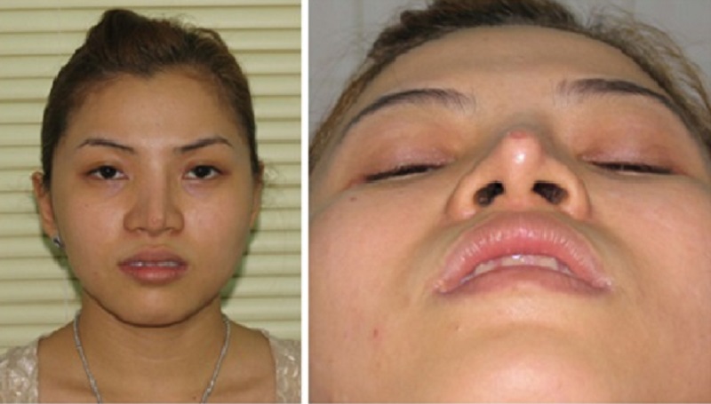 Phẫu thuật mũi hỏng gây lệch vẹo rất thường gặp trong thẩm mỹ