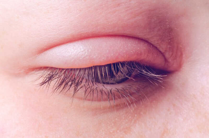 Viêm kết mạc có thể dẫn đến tình trạng mí mắt bị sưng