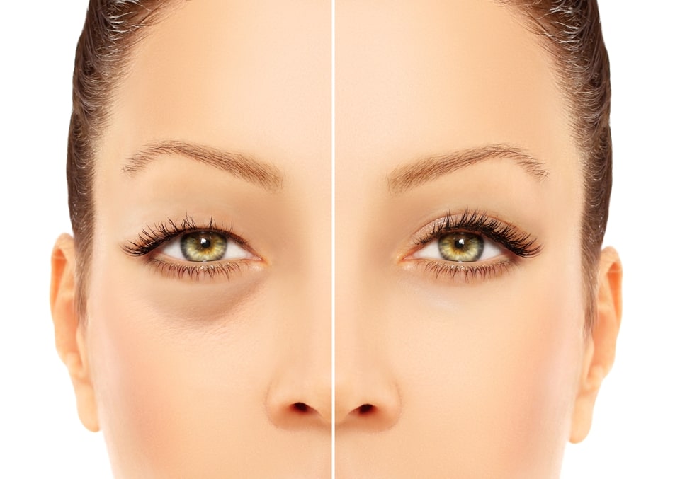 Cắt bọng mỡ mắt phù hợp với người bắt đầu xuất hiện dấu hiệu lão hóa mắt