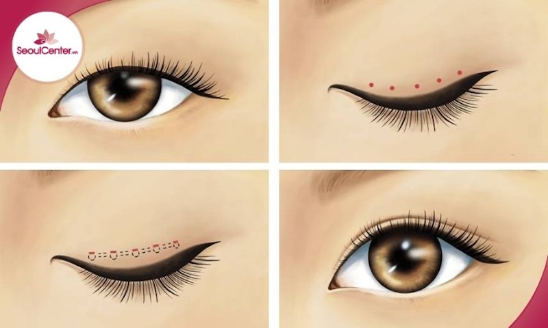 Nhấn mí Dove Eyes là phương pháp sử dụng kỹ thuật liên kết da mí mắt với sụn mi bằng chỉ thẩm mỹ chuyên dụng