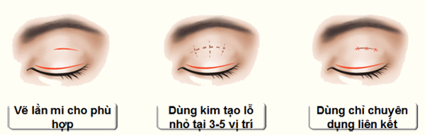 Hình 2: Mô phỏng kỹ thuật nhấn mí mắt
