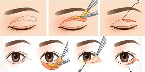Hình 3: Mô phỏng kỹ thuật cắt mí mắt