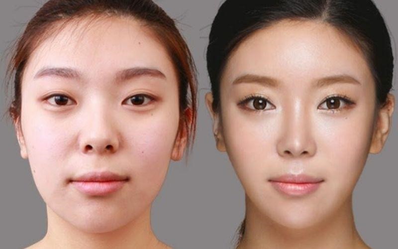 Chiếc mũi thay đổi giúp khuôn mặt cân đối, đẹp tự nhiên hơn
