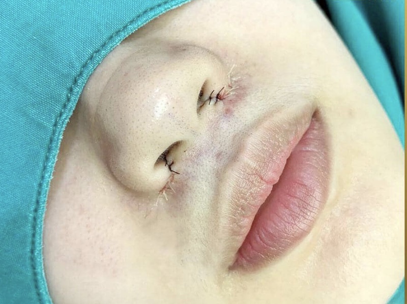 Nâng mũi là phương pháp tiểu phẫu được thực hiện đơn giản và an toàn