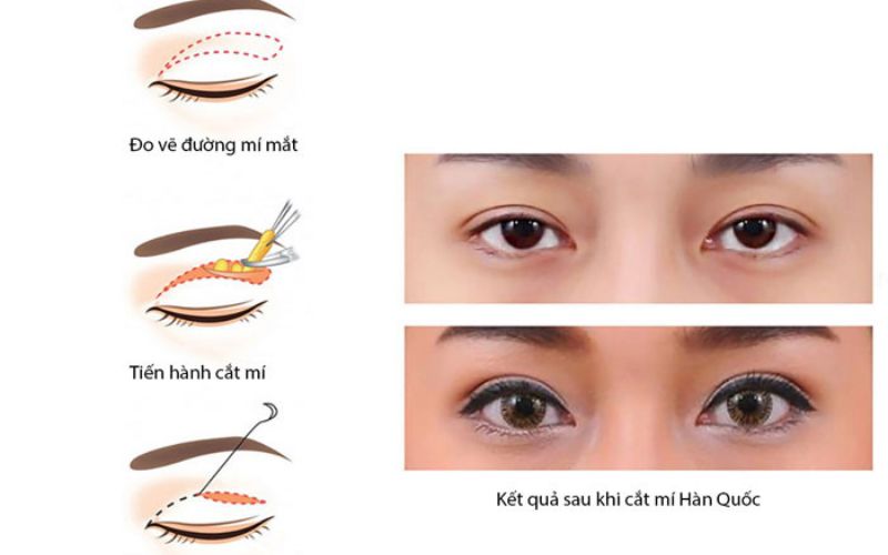 Phương pháp cắt mí mắt giúp trẻ hóa đôi mắt toàn diện