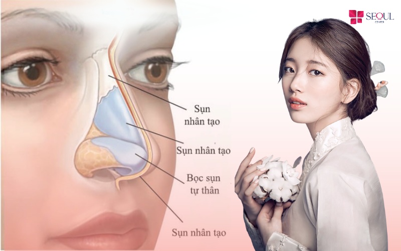 Không thực hiện nâng mũi hoàn toàn bằng sụn tai vì dễ gây ra biến chứng co rút, biến dạng đầu mũi