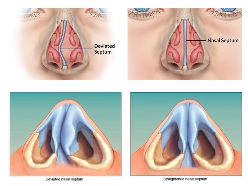 Hình ảnh mũi bình thường và mũi bị lệch vách ngăn