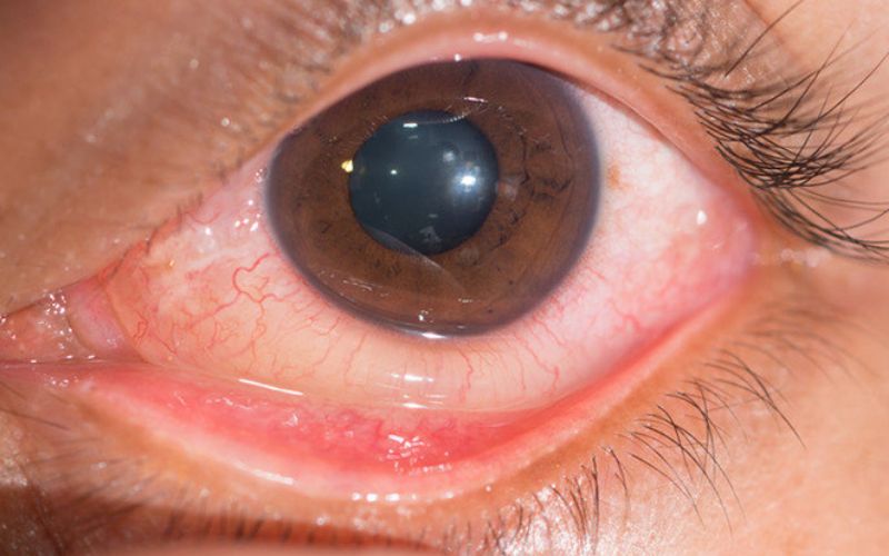 Sạn vôi trong mắt là một bệnh lý thường thấy hiện nay